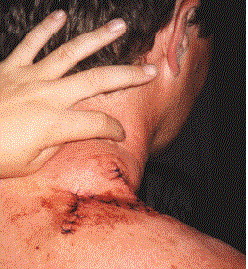 animated gif showing 4 picture slide show of excision results